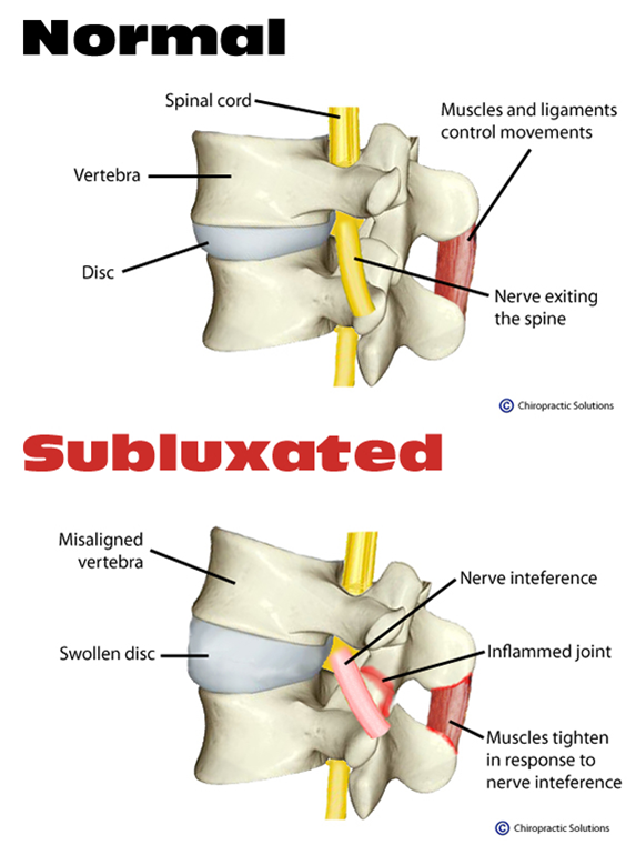 Understanding Spinal Subluxation