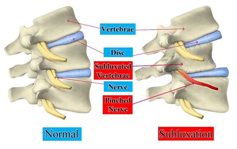 Understanding Spinal Subluxation