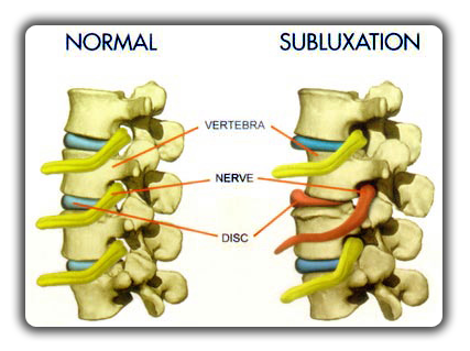 Understanding Spinal Subluxation